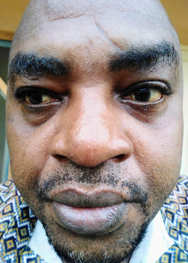 img 20221101 wa00257E25779602490525277433. Lagos-based 50 years old Ikenna Harrison Udeze, has been diagnosed with eye deficiency known as cataract and needs urgent surgery to restore his eyesight to normal.
In a doctor's report dated 27th September 2022, Ikenna's right eye is infected with cataract anterior subcapsular polar presenile, while both eyes have cataract cortical senile.
He lives at No 23 Lamidi Ariyo Street off community road, Ago palace way, Lagos.
Please note: this aid is not meant to raise financial support for the subject, it only requires interested helpers to recommend Mr Ikenna for free cataract surgery.
Interested supporters can call Ikenna Udeze on +234 817 041 2764. Doctor's Report